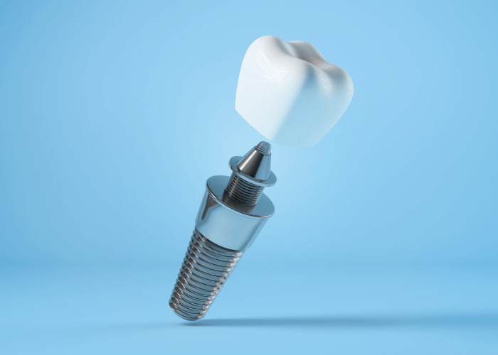 About dental implants in Tampa, FL at Solace Dental of Tampa