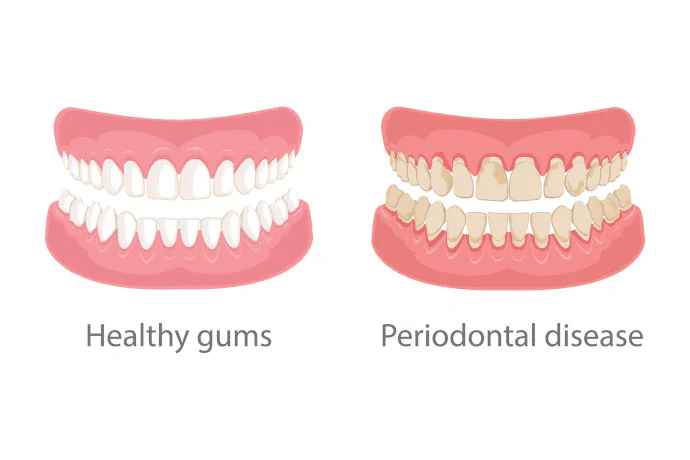 Gum Disease Treatment