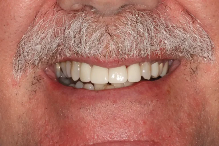 After Dental Crowns in Tampa, FL at Solace Dental of Tampa