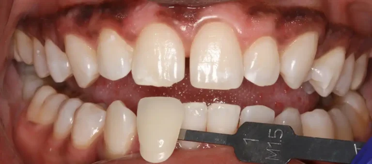 After Professional Teeth Whitening in Tampa, FL at Solace Dental of Tampa