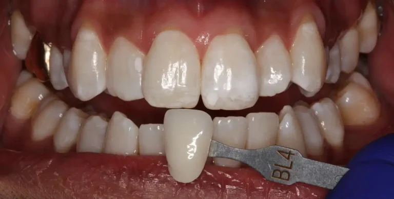 After Teeth Whitening in Tampa, FL at Solace Dental of Tampa