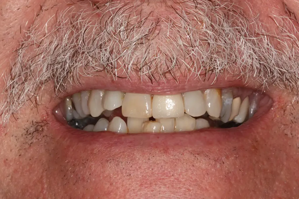 Before Dental Crowns in Tampa, FL at Solace Dental of Tampa