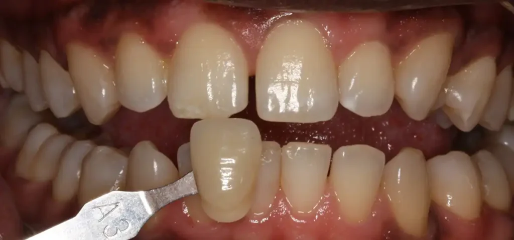 Before Professional Teeth Whitening in Tampa, FL at Solace Dental of Tampa