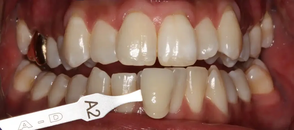 Before Teeth Whitening in Tampa, FL at Solace Dental of Tampa