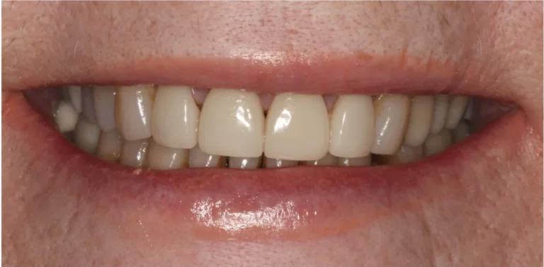 After dental veneers at Solace Dental of Tampa in Tampa, FL