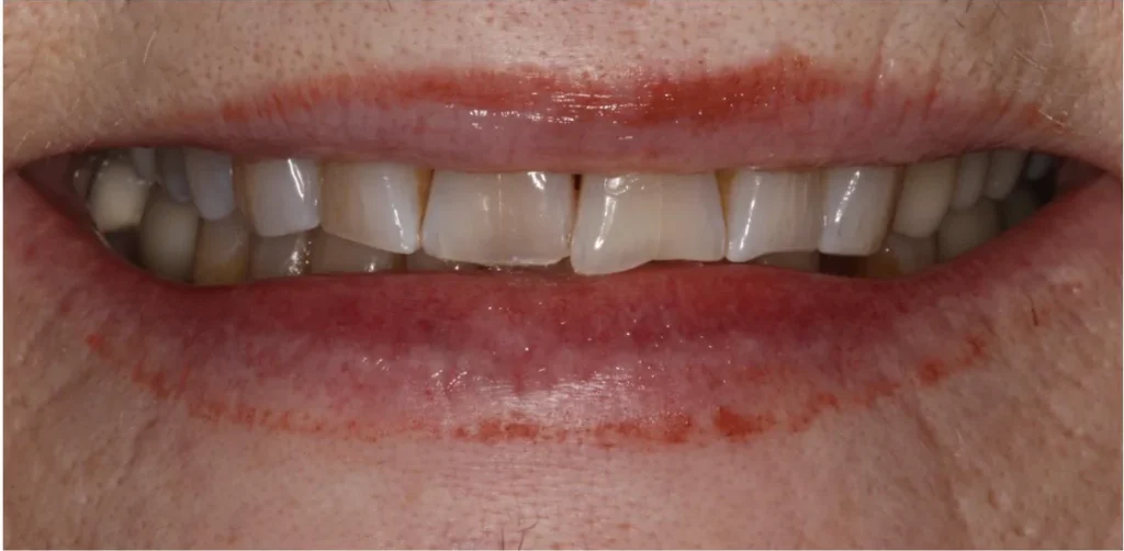 Before dental veneers at Solace Dental of Tampa in Tampa, FL