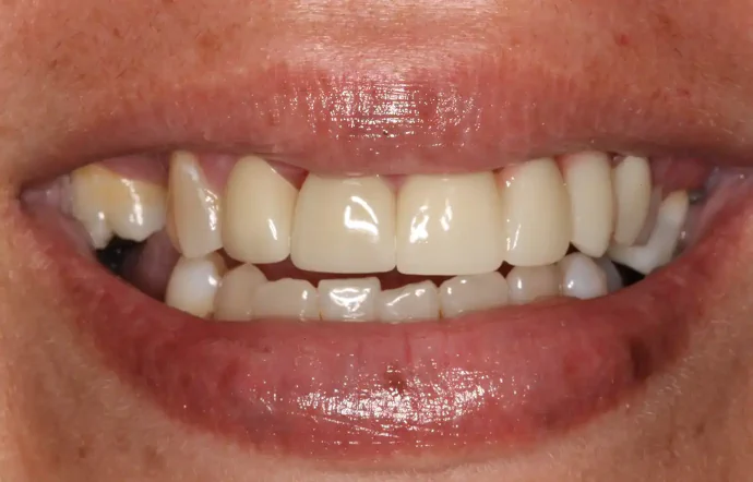 After Dental Crowns in Tampa, FL at Solace Dental of Tampa
