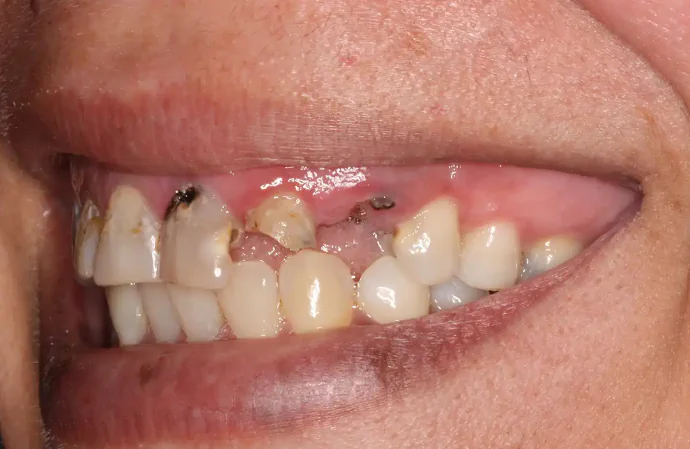 Before Dental Bridge in Tampa, FL at Solace Dental of Tampa
