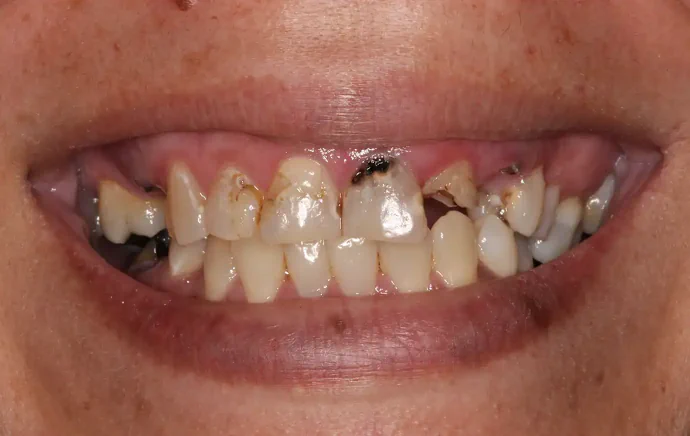 Before Dental Crowns in Tampa, FL at Solace Dental of Tampa